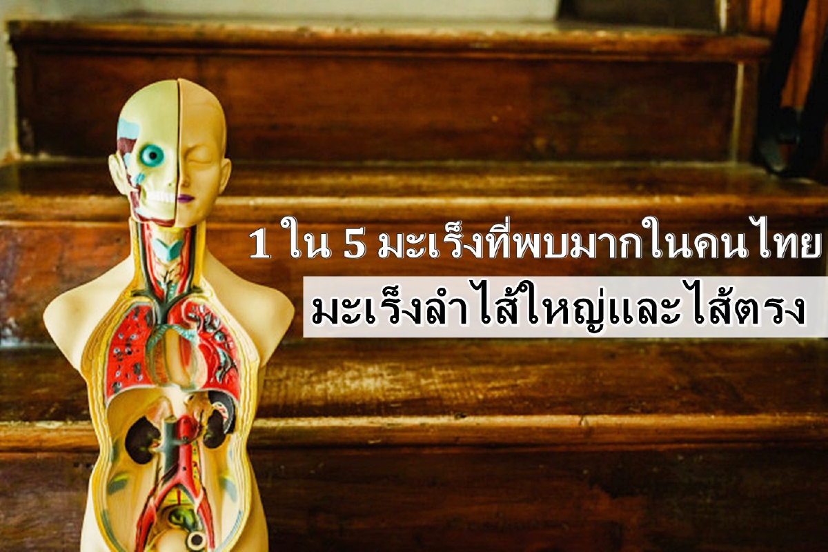 1 ใน 5 มะเร็งที่พบมากในคนไทย "มะเร็งลำไส้ใหญ่และไส้ตรง" 1 ใน 5 มะเร็งที่พบมากในคนไทย "มะเร็งลำไส้ใหญ่และไส้ตรง"
