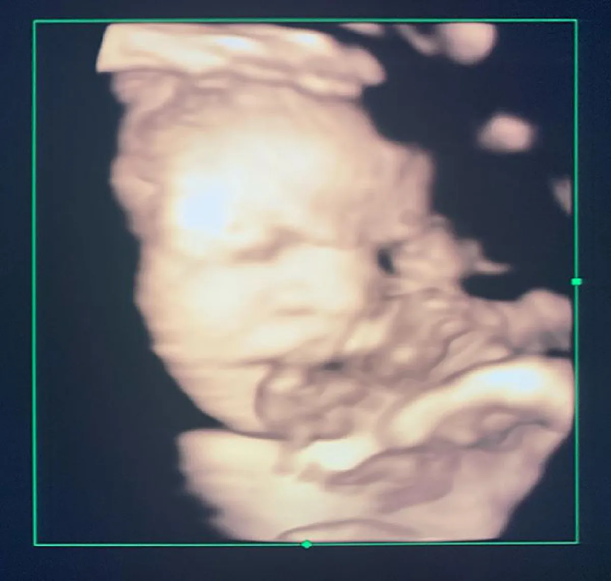 กุ๊บกิ๊บ เผยภาพอัลตร้าซาวด์ลูกก่อนคลอด พร้อมชวนแฟนๆทายเพศ