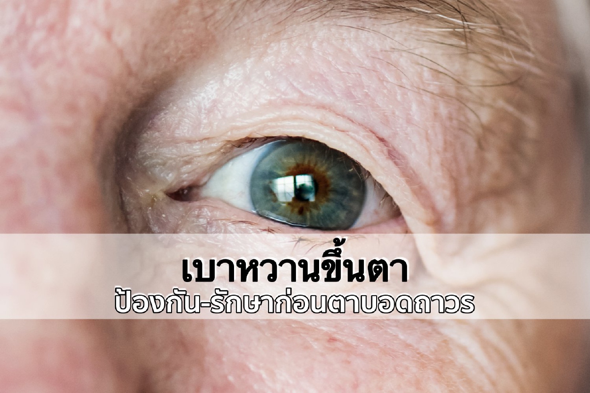 'เบาหวานขึ้นตา' ป้องกัน-รักษาก่อนตาบอดถาวร 'เบาหวานขึ้นตา' ป้องกัน-รักษาก่อนตาบอดถาวร