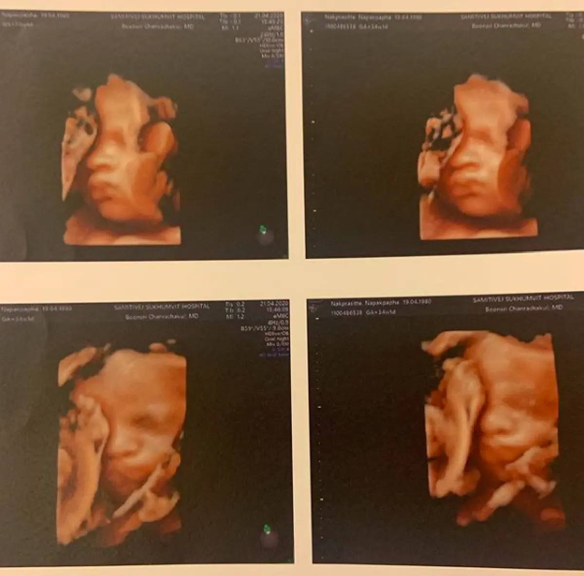 ”มะหมี่ นภคปภา” คลอดลูกสาวฝาแฝดเป็นที่เรียบร้อยแล้ว น่ารักน่าเอ็นดูสุดๆ 