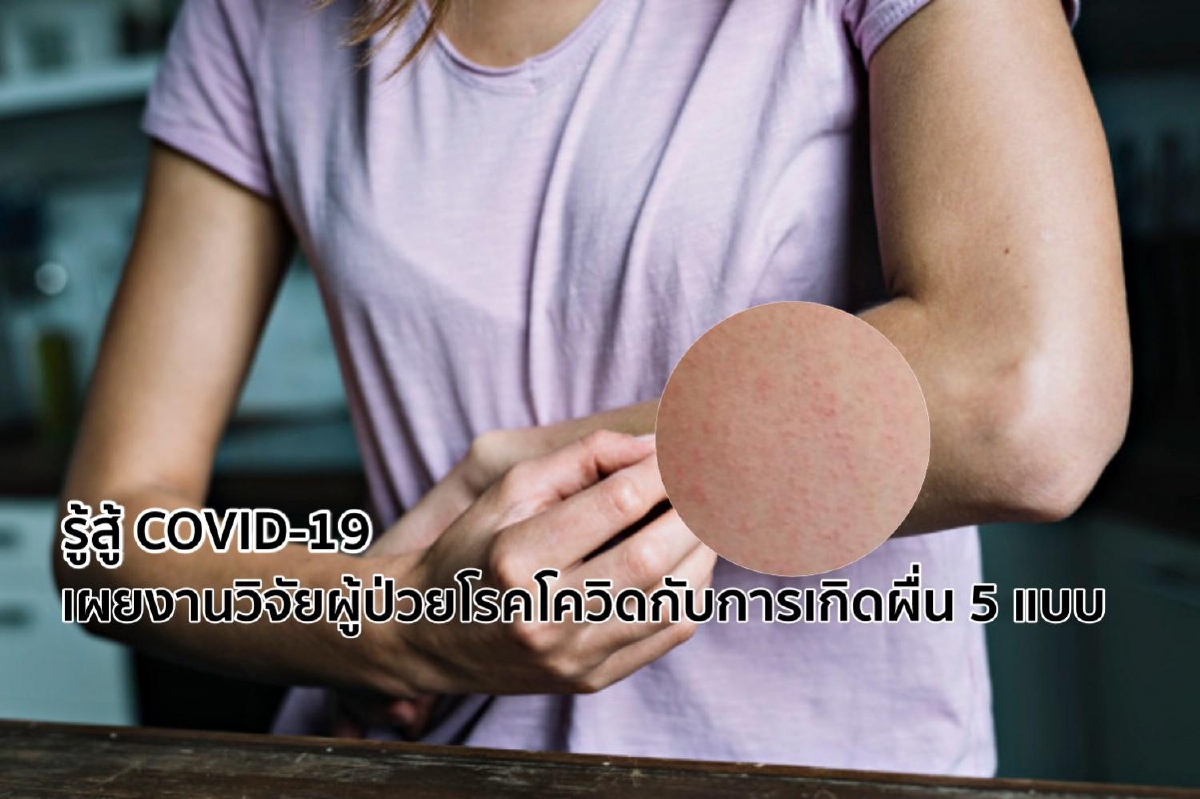 รู้สู้ COVID-19 เผยงานวิจัยผู้ป่วยโรคโควิดกับการเกิดผื่น 5 แบบ รู้สู้ COVID-19 เผยงานวิจัยผู้ป่วยโรคโควิดกับการเกิดผื่น 5 แบบ