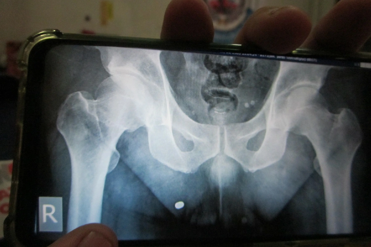 หนุ่มลูกชิ้นถูกตำรวจยิงหวั่นสำนวนคดีพยายามฆ่าอ่อน