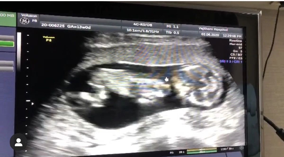 "ต๊ะ บอยสเก๊าท์" เผยภาพอัลตร้าซาวด์ลูกคนแรก บอกชัดลูกพ่อชัวร์!