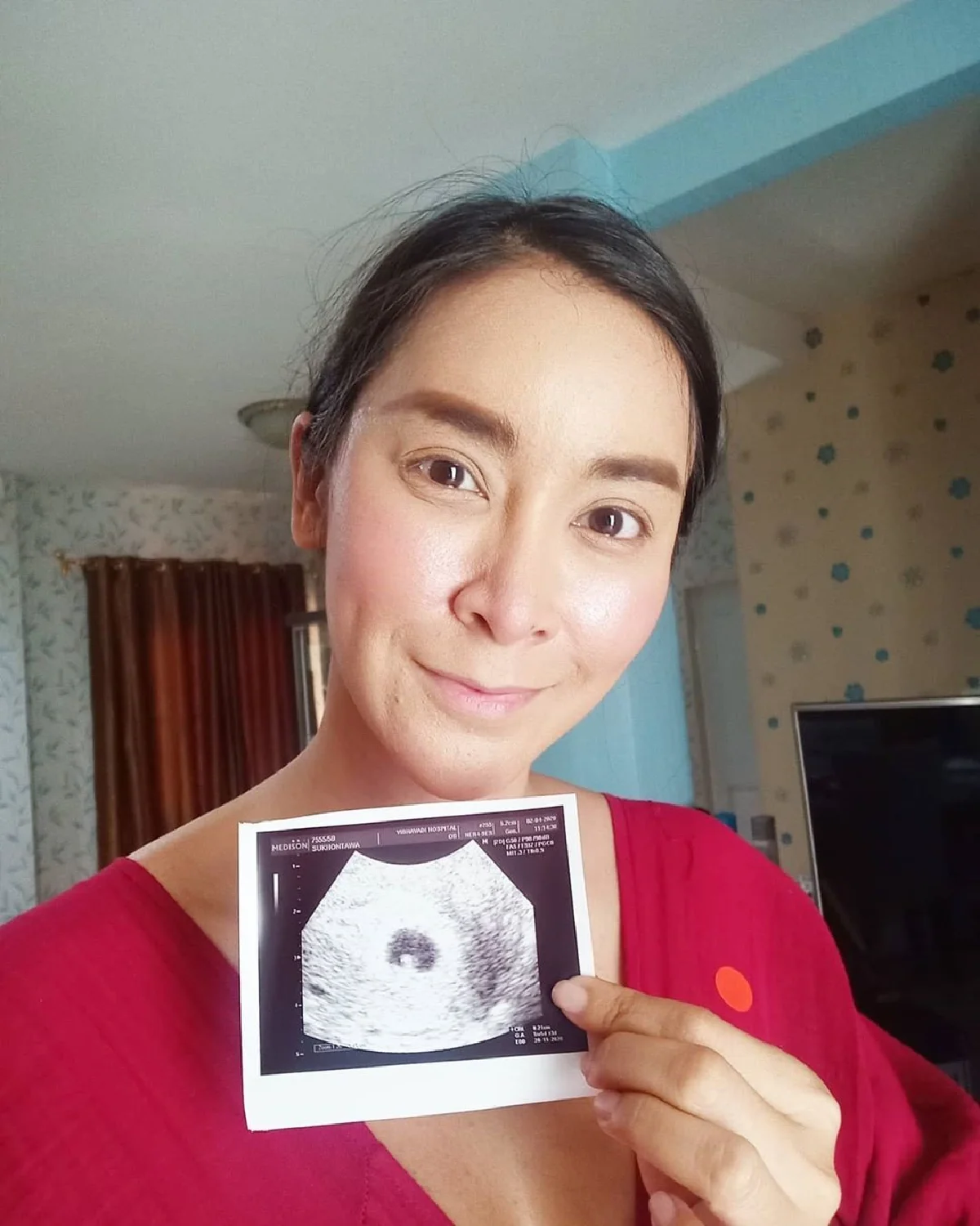 ใหม่ สุคนธวา แพ้ท้องหนักมาก! เผยหน้าสดสิวเห่อ-ผมร่วง หน้าพังที่สุดในชีวิต