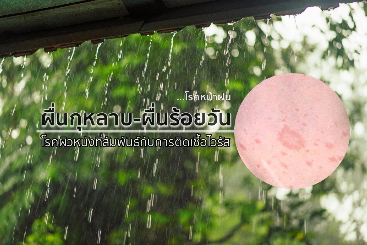 ผื่นกุหลาบ-ผื่นร้อยวัน โรคผิวหนังที่สัมพันธ์กับการติดเชื้อไวรัส ผื่นกุหลาบ-ผื่นร้อยวัน โรคผิวหนังที่สัมพันธ์กับการติดเชื้อไวรัส