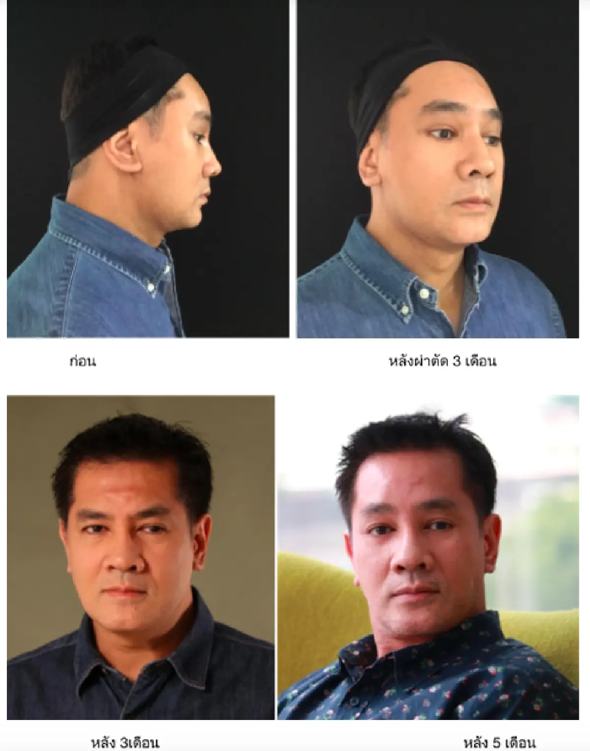 "ต้น จักรกฤษณ์” เปิดใจครั้งแรก หลังตัดสินใจทำศัลยกรรมครั้งใหญ่นานถึง 8 ชั่วโมง