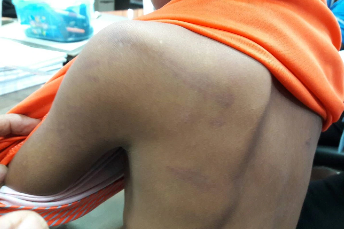 ตำรวจบ้านโป่งเรียกครูผู้ปกครองหารือป.1ถูกเฆี่ยนจนไข้ขึ้น