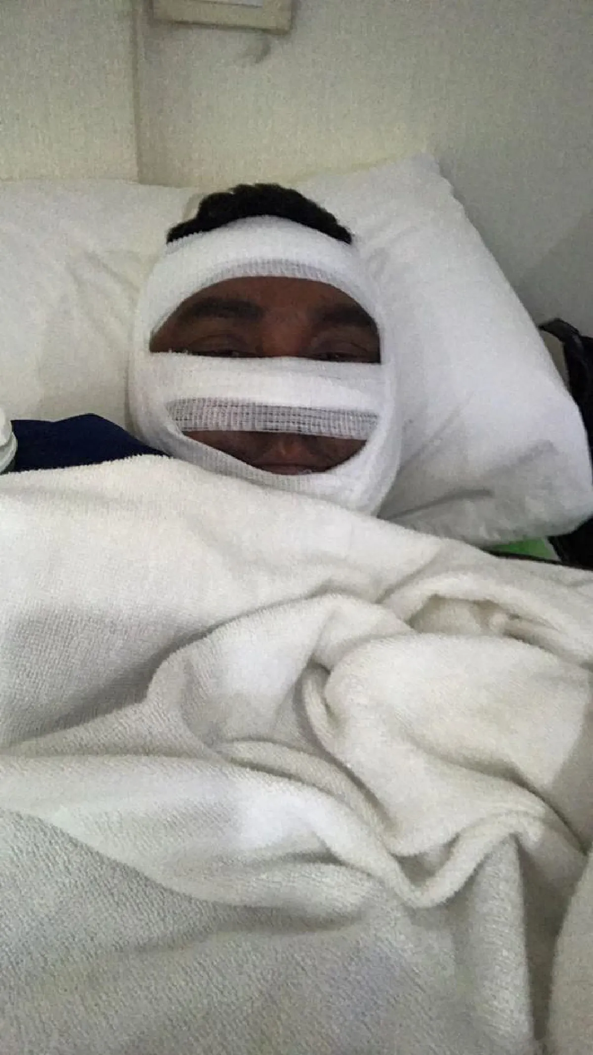 วินัย ไกรบุตร เผยภาพพันผ้าก็อซบริเวณใบหน้า บำบัดอาการป่วยต่อเนื่อง