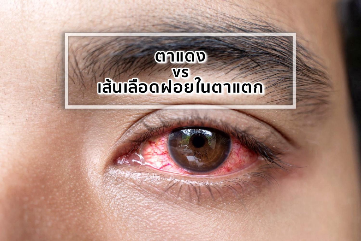 ตาแดง vs เส้นเลือดฝอยในตาแตก แตกต่างกันหรือไม่ ตาแดง vs เส้นเลือดฝอยในตาแตก แตกต่างกันหรือไม่