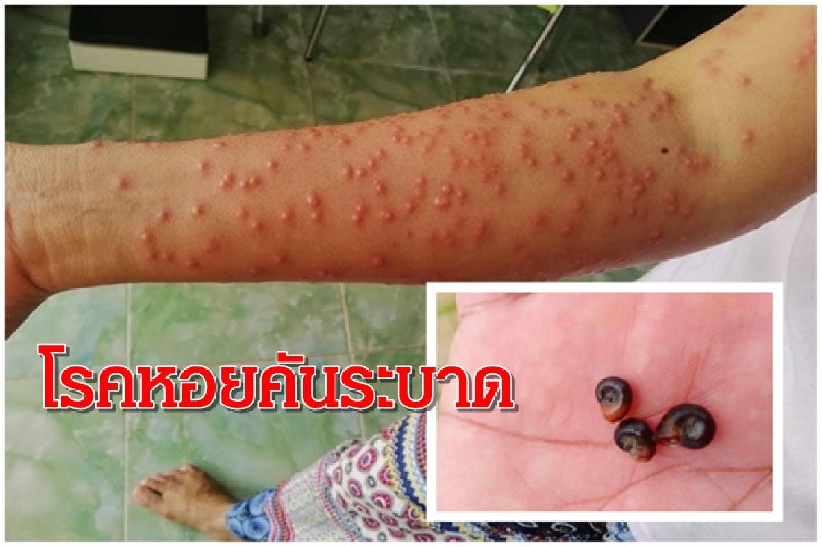เตือนชาวนาระวังโรคหอยคันระบาด พบแล้ว 7 ตำบล ในอ.จะนะ เตือนชาวนาระวังโรคหอยคันระบาด พบแล้ว 7 ตำบล ในอ.จะนะ