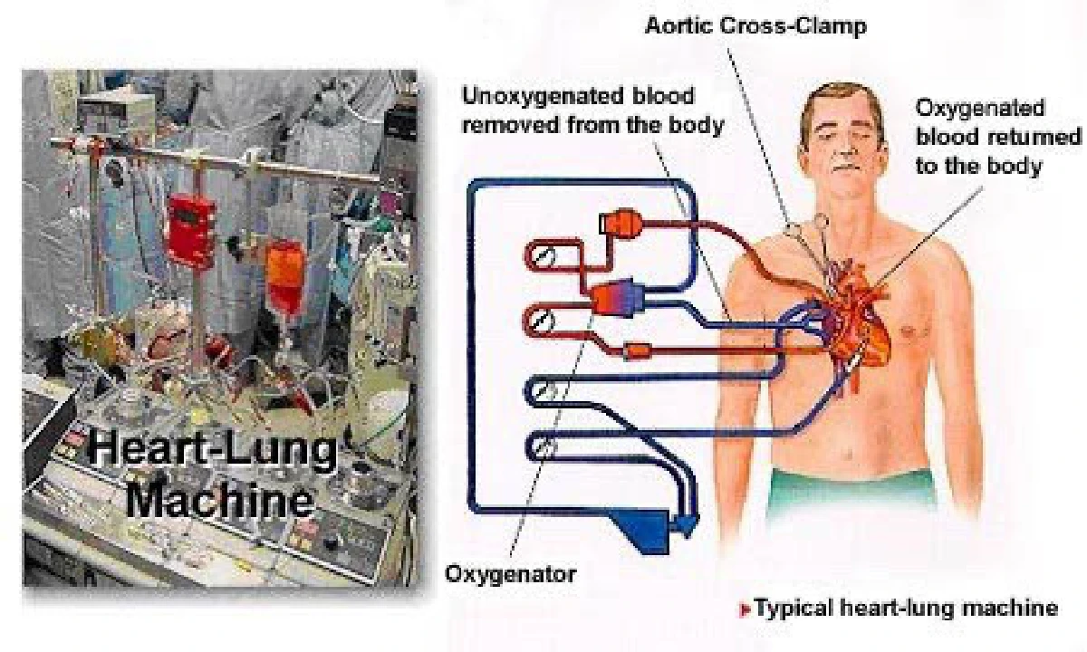 ถาม-ตอบ : เรื่องใหญ่เมื่อต้องผ่าตัดหัวใจและทรวงอก 