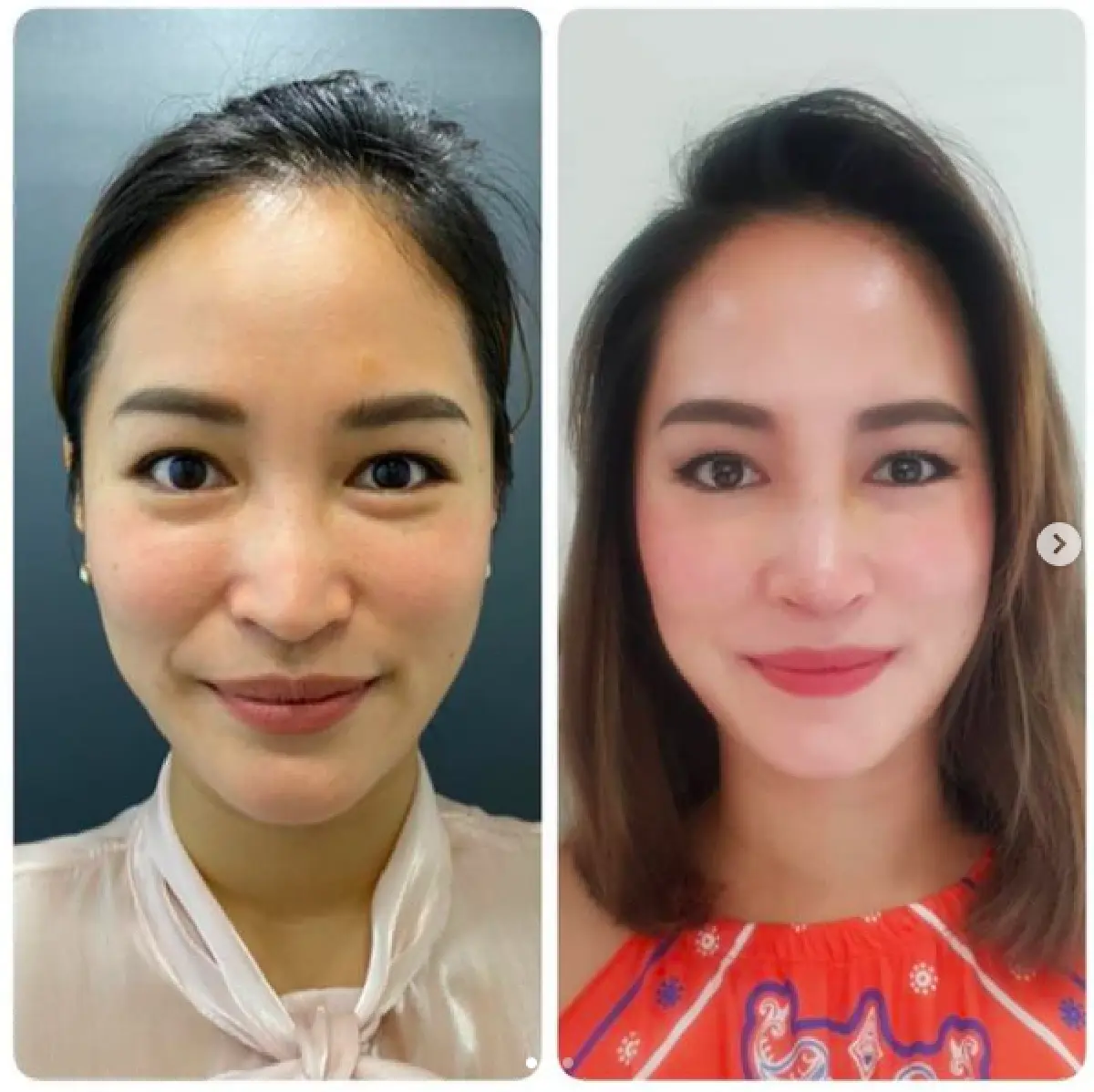 “พลอย พลอยพรรณ” เผยภาพก่อน-หลังอัปดั้ง แววสวยมาแล้วแม้จะยังไม่เข้าที่