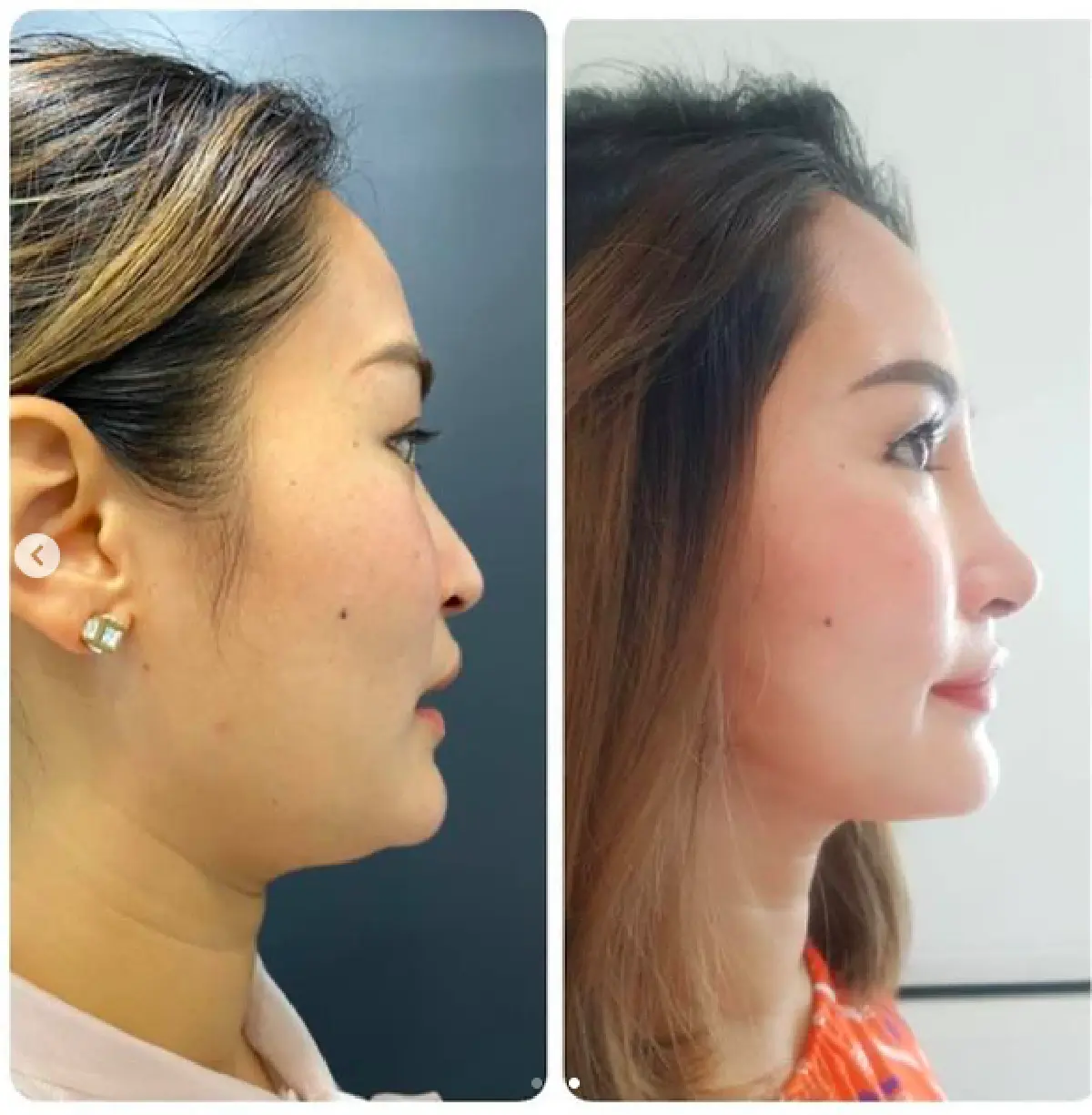 “พลอย พลอยพรรณ” เผยภาพก่อน-หลังอัปดั้ง แววสวยมาแล้วแม้จะยังไม่เข้าที่