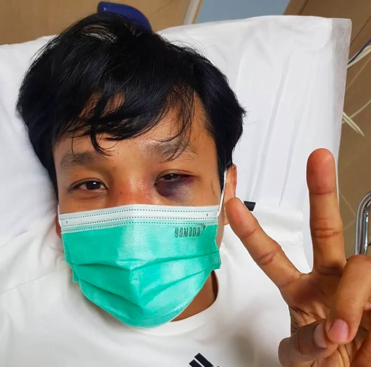 "เอ็กซ์ ธิตินันท์" อัปเดตอาการวันที่ 2 หลังชกกับ "รัศมีแข" เบ้าตาแตก จมูกอ่อนหักสองข้าง