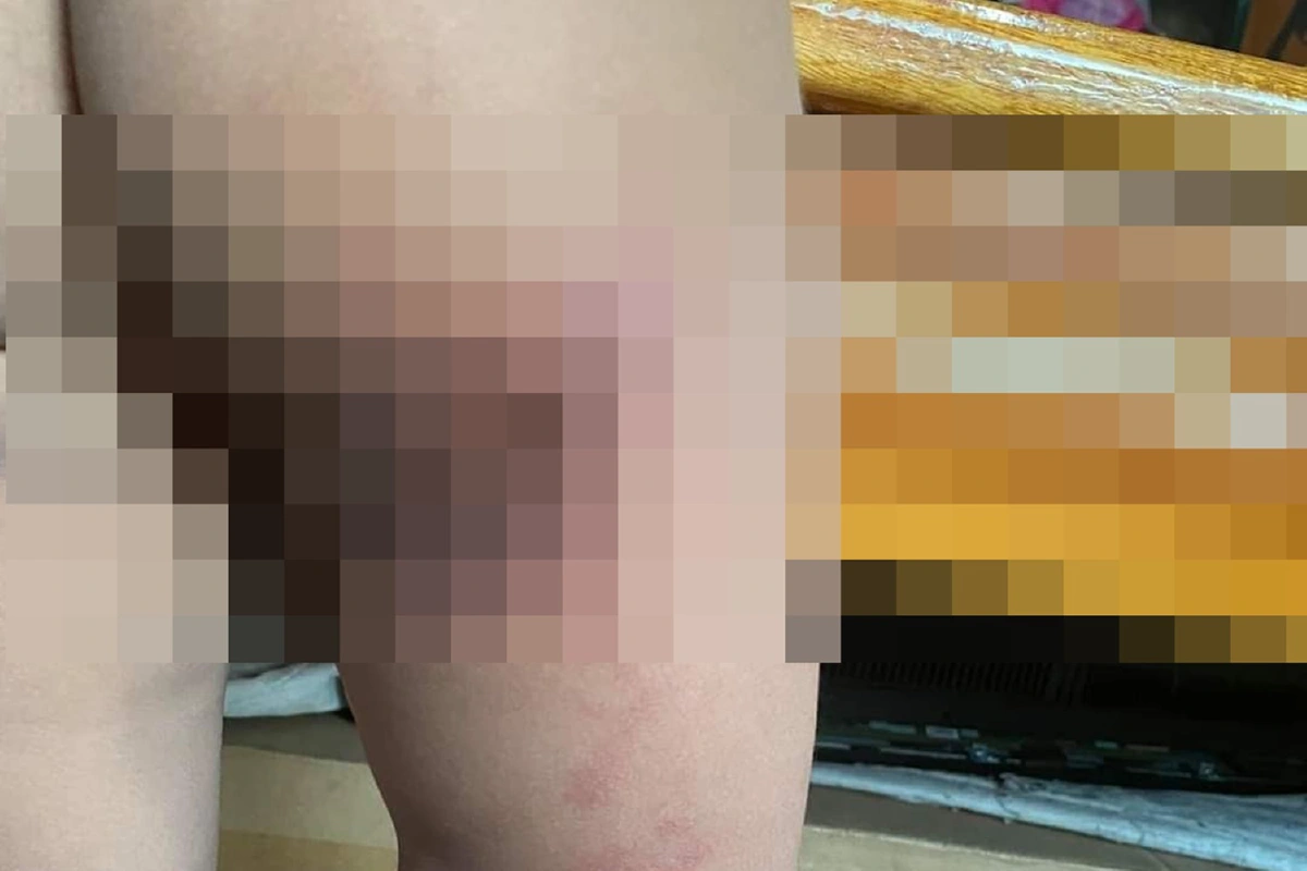 แม่โวยลูกสาว3ขวบเป็นแผลที่ก้น-ขาขวา ครูยันไม่ได้ทำร้ายเด็ก