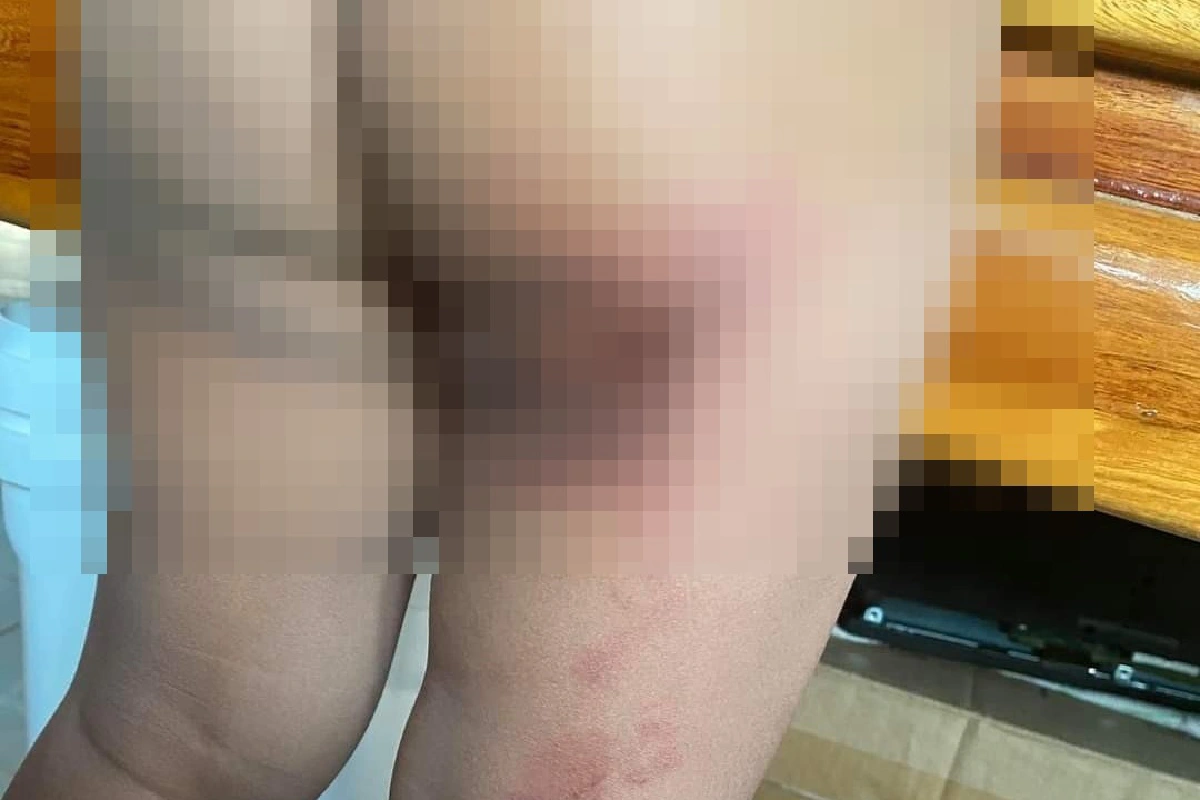 แม่โวยลูกสาว3ขวบเป็นแผลที่ก้น-ขาขวา ครูยันไม่ได้ทำร้ายเด็ก