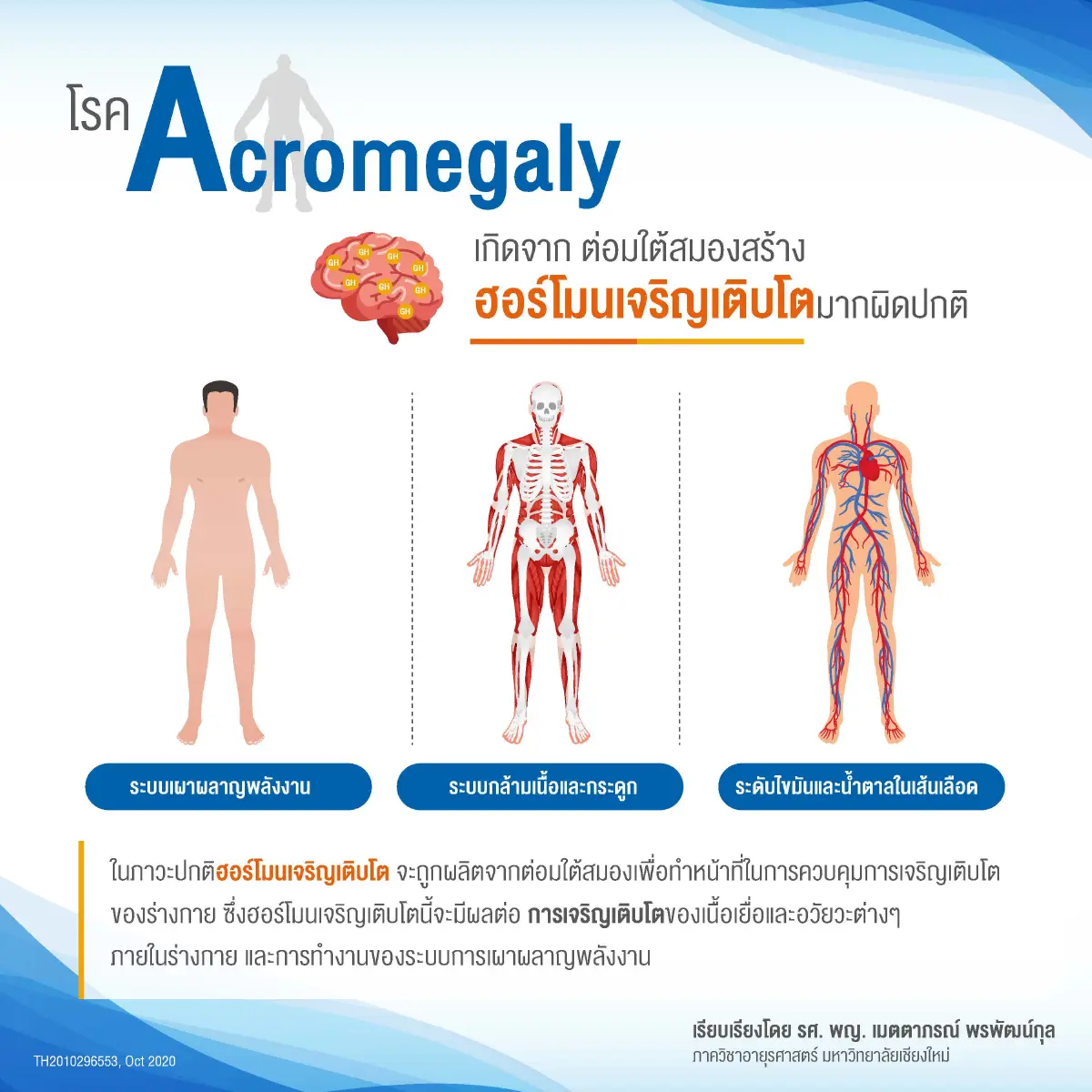 'อะโครเมกาลี' โรคหายากที่สิทธิบัตรทองใช้รักษาได้