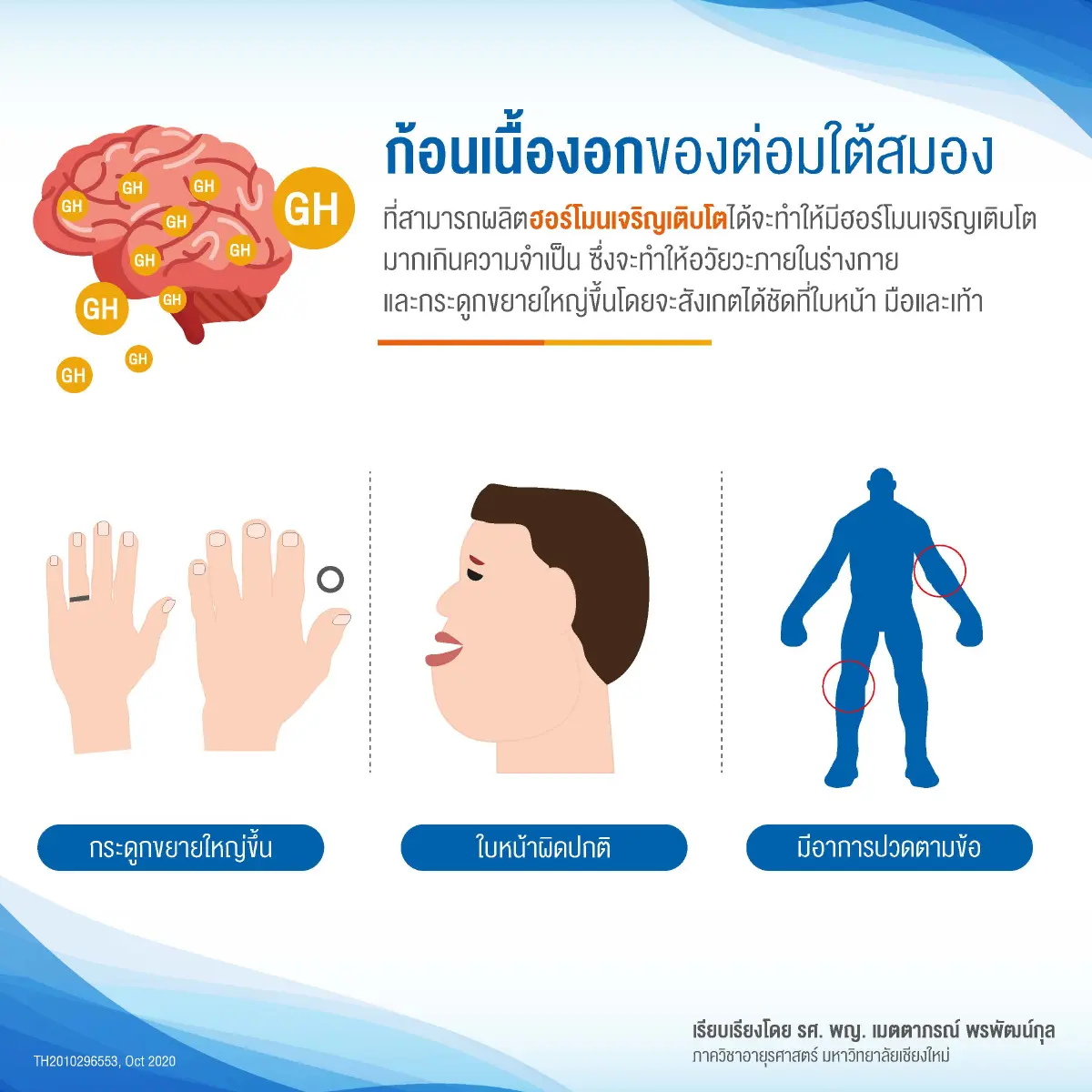 'อะโครเมกาลี' โรคหายากที่สิทธิบัตรทองใช้รักษาได้