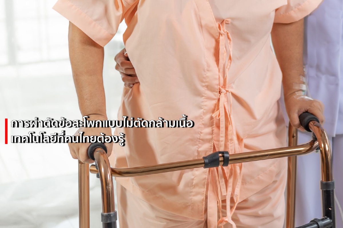 การผ่าตัดข้อสะโพกแบบไม่ตัดกล้ามเนื้อ เทคโนโลยีที่คนไทยต้องรู้ การผ่าตัดข้อสะโพกแบบไม่ตัดกล้ามเนื้อ เทคโนโลยีที่คนไทยต้องรู้