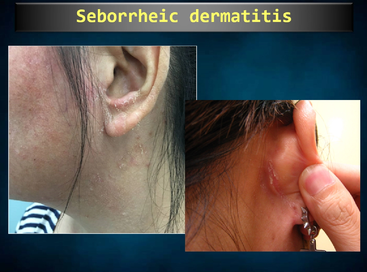 'เซ็บเดิร์ม' โรครังแคที่ไม่ได้คันแค่หัว แต่ลามถึงหน้าและลำตัวได้