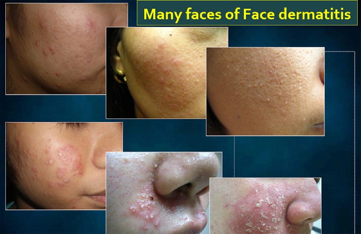 'เซ็บเดิร์ม' โรครังแคที่ไม่ได้คันแค่หัว แต่ลามถึงหน้าและลำตัวได้