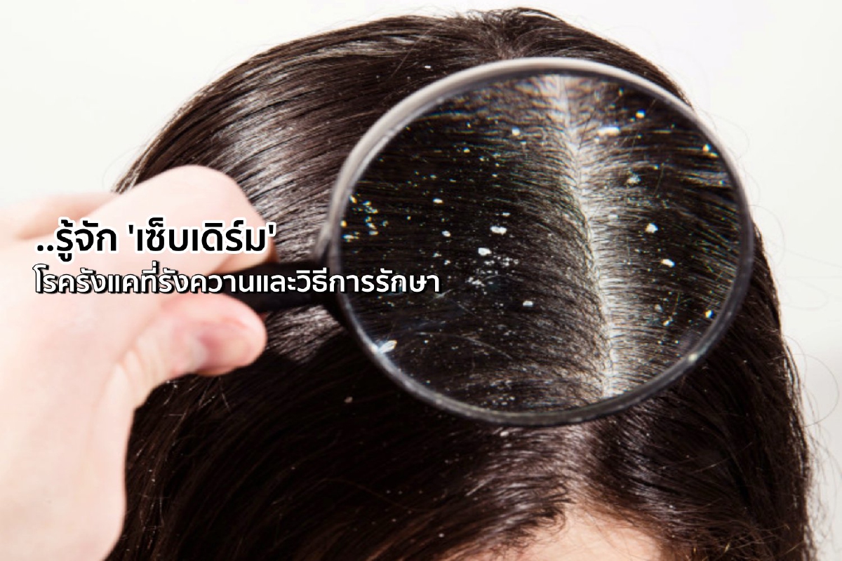 'เซ็บเดิร์ม' โรครังแคที่ไม่ได้คันแค่หัว แต่ลามถึงหน้าและลำตัวได้ 'เซ็บเดิร์ม' โรครังแคที่ไม่ได้คันแค่หัว แต่ลามถึงหน้าและลำตัวได้