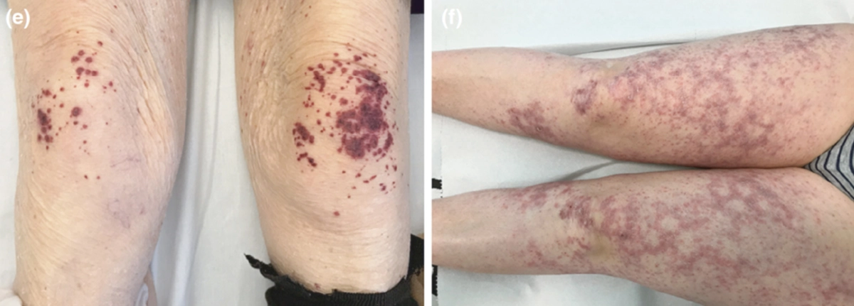 โรคโควิด  ผิวหนัง และหัตถการความงาม