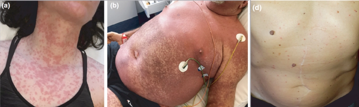 โรคโควิด  ผิวหนัง และหัตถการความงาม