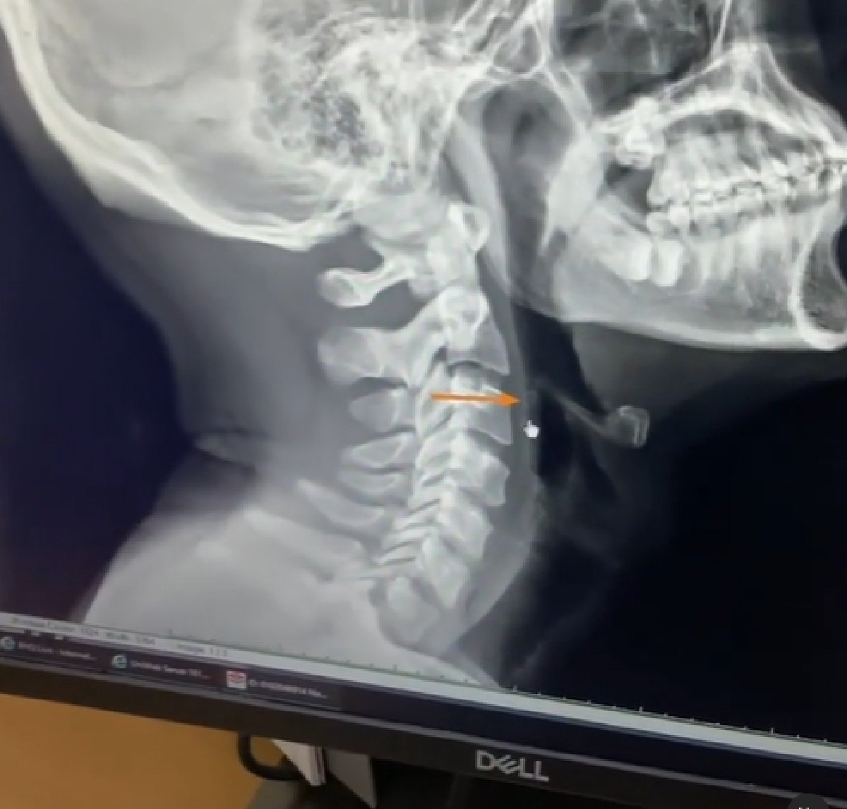 หอยติดคอ! เป๊ก เปรมณัช เผยเหตุรีบไปรพ.ด่วน หลังทานหอยเชลล์