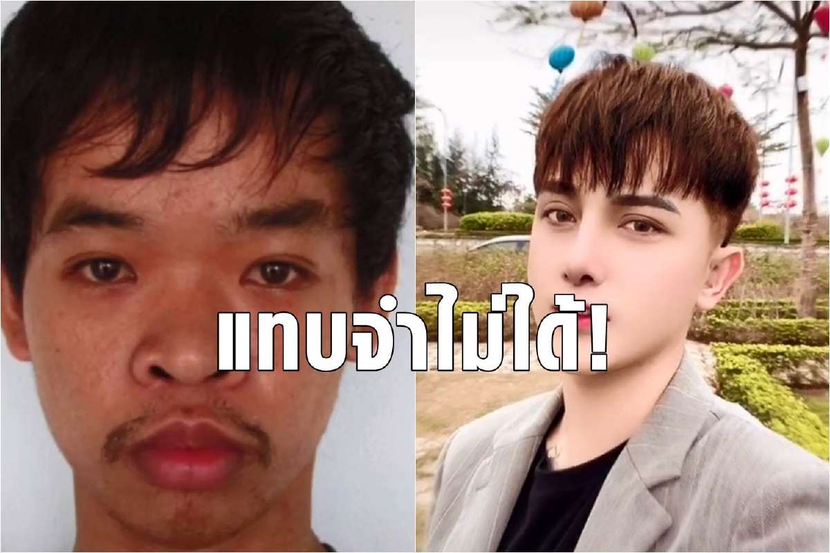หนุ่มเวียดนามหางานไม่ได้เพราะไม่หล่อ ทุ่มครึ่งล้านศัลย์ทั้งหน้า หนุ่มเวียดนามหางานไม่ได้เพราะไม่หล่อ ทุ่มครึ่งล้านศัลย์ทั้งหน้า