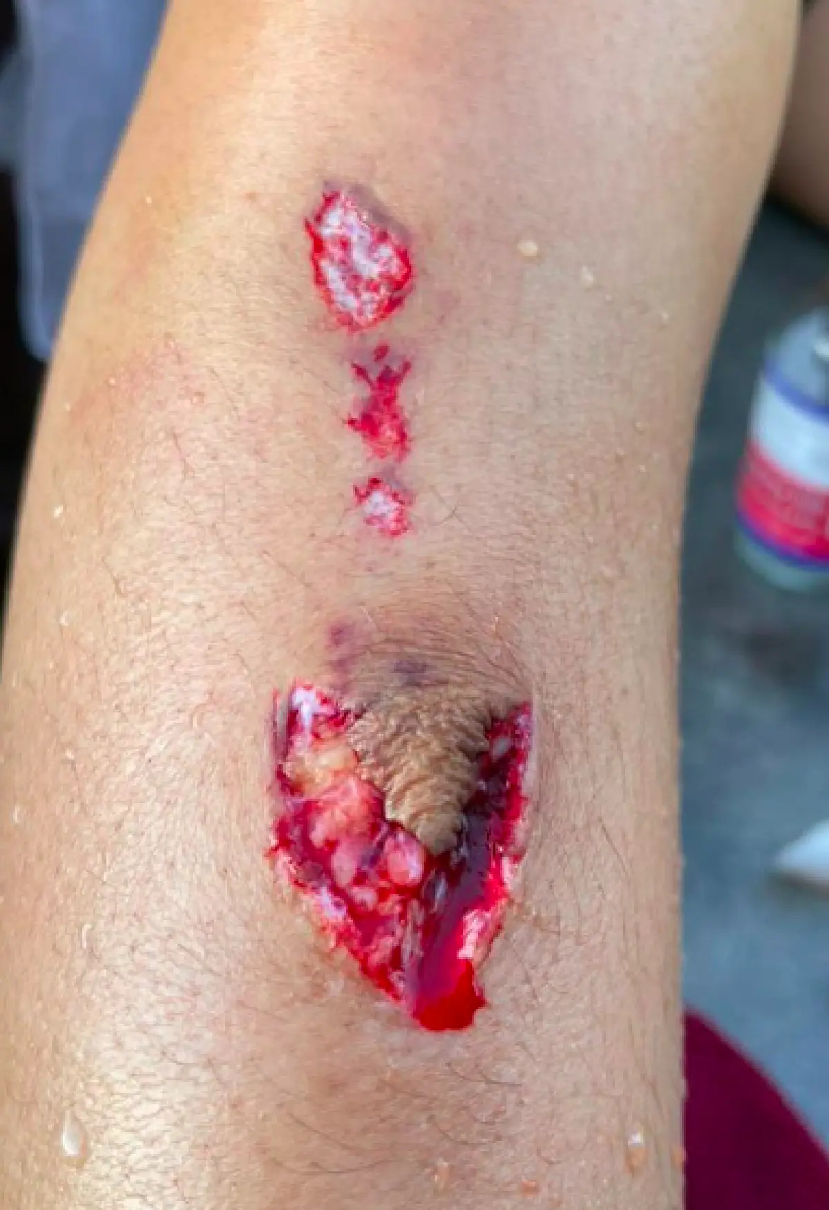 "กระแต อาร์สยาม" ลื่นล้มขาฟาดขอบสระเป็นแผลลึกฉกรรจ์  โดนเย็บ 17 เข็ม