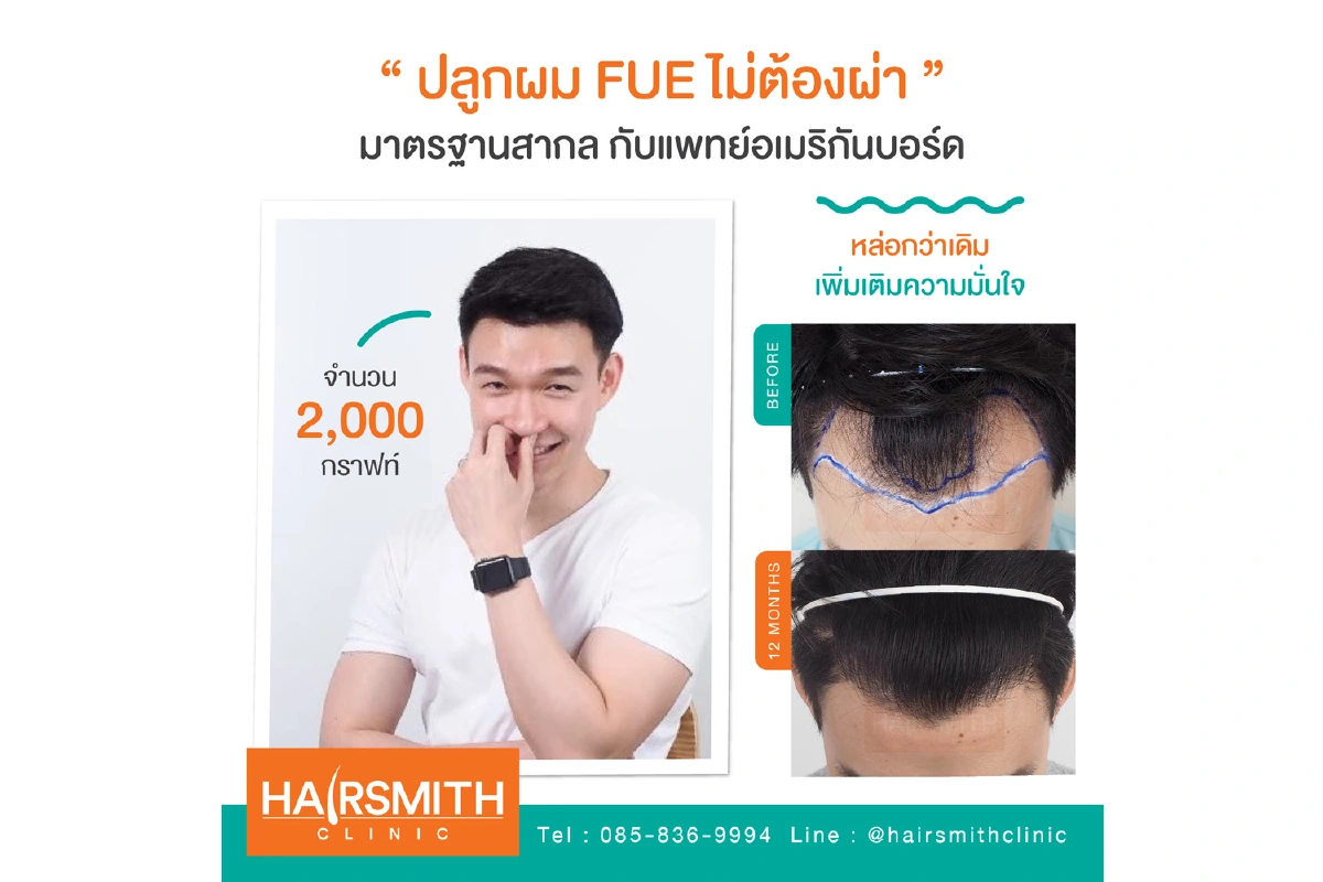 ปลูกผมแก้ไขปัญหาหัวล้านอย่างตรงจุด