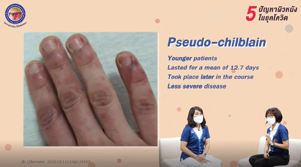 Covid-19 : 'ผื่น' อาการทางผิวหนังที่ไม่ควรมองข้าม