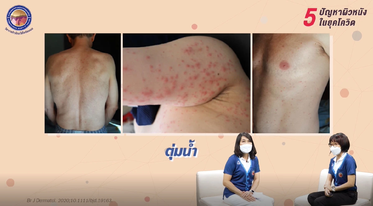 Covid-19 : 'ผื่น' อาการทางผิวหนังที่ไม่ควรมองข้าม