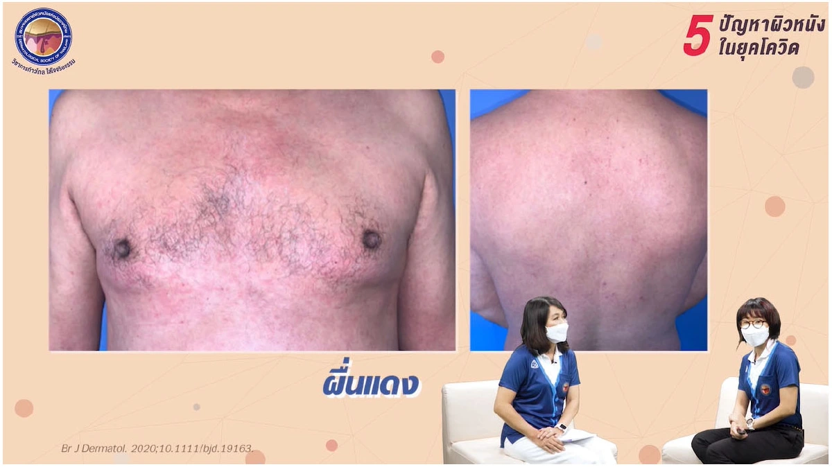 Covid-19 : 'ผื่น' อาการทางผิวหนังที่ไม่ควรมองข้าม