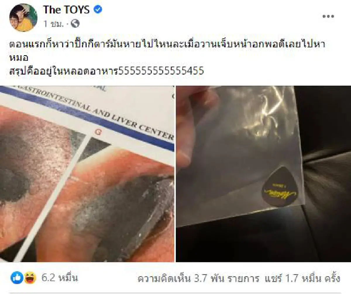 เธอคือที่สุด! “เดอะทอยส์” ทำปิ๊กกีตาร์หาย เจออีกทีอยู่ในหลอดอาหาร 