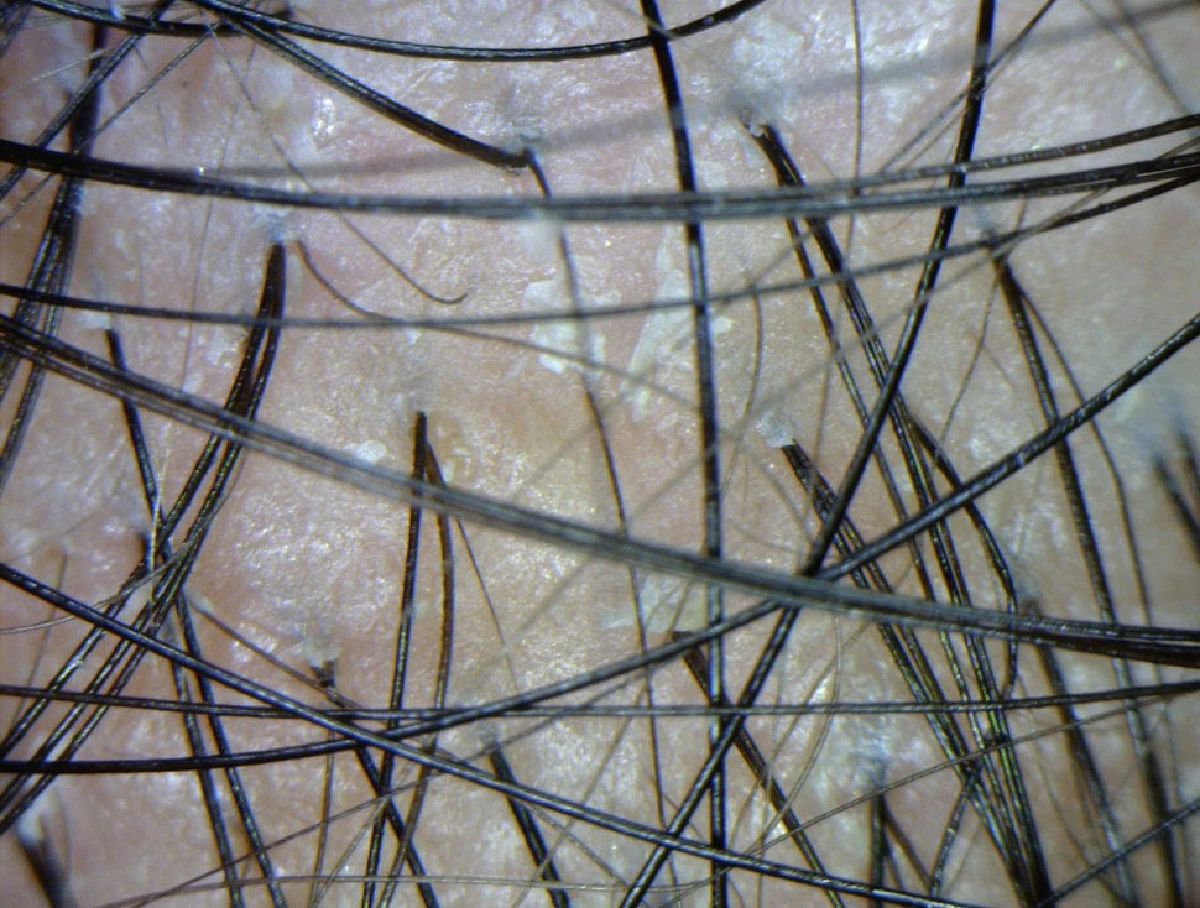 ซูมให้ดู รู้ให้ลึก 5 ปัญหาเส้นผมและหนังศีรษะ