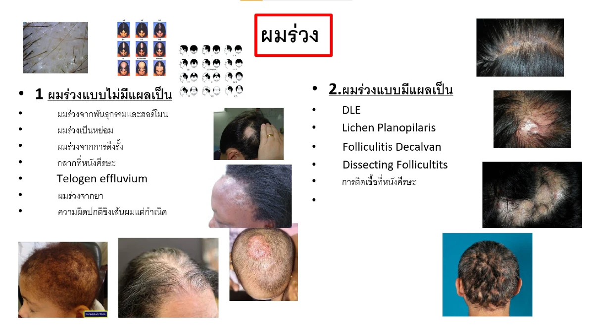 ซูมให้ดู รู้ให้ลึก 5 ปัญหาเส้นผมและหนังศีรษะ