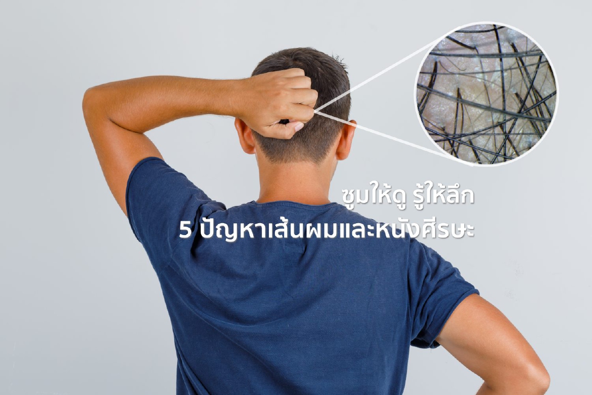 ซูมให้ดู รู้ให้ลึก 5 ปัญหาเส้นผมและหนังศีรษะ ซูมให้ดู รู้ให้ลึก 5 ปัญหาเส้นผมและหนังศีรษะ