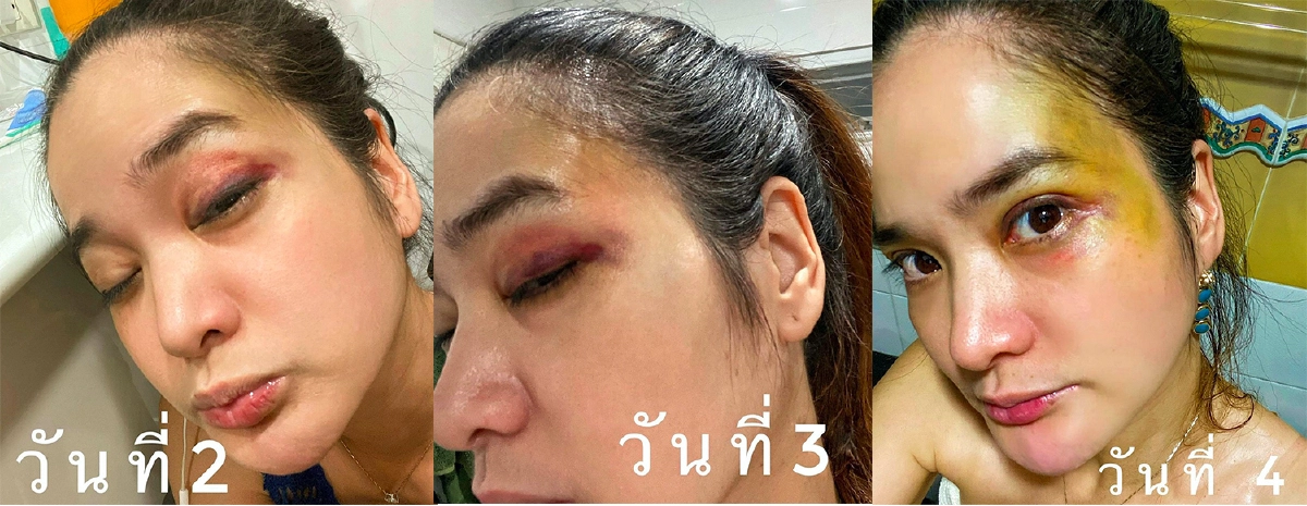 “ปอย ปวีณา” เล่นสเกตบอร์ดแบบไม่มีอุปกรณ์ป้องกัน ล้มหน้าฟาดพื้นหวิดเสียโฉม