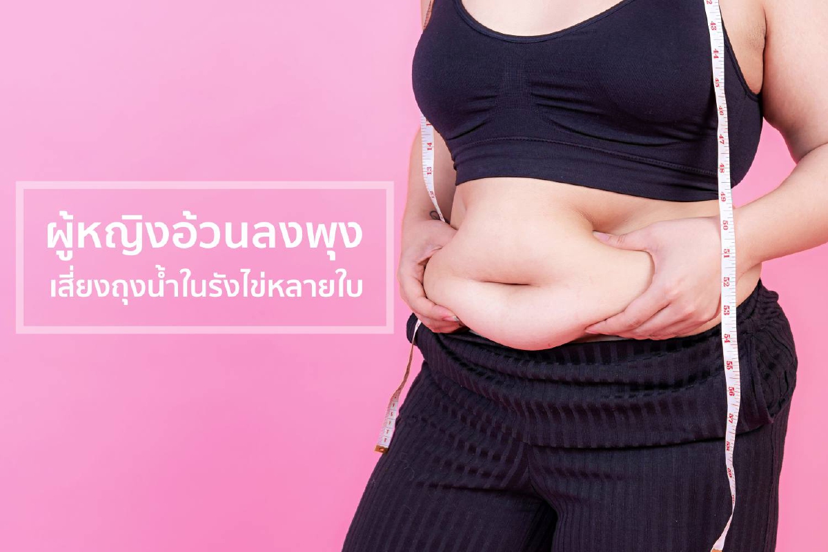 ผู้หญิงอ้วนลงพุง เสี่ยงถุงน้ำในรังไข่หลายใบ ผู้หญิงอ้วนลงพุง เสี่ยงถุงน้ำในรังไข่หลายใบ