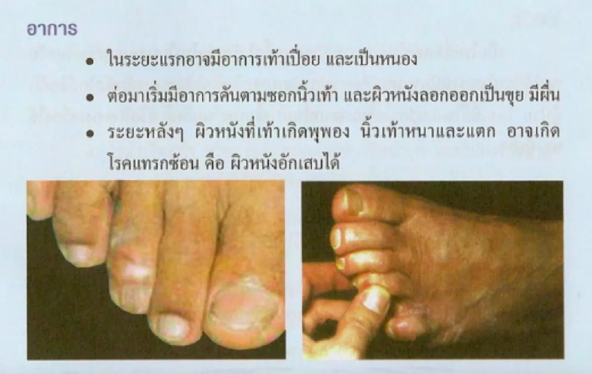 'น้ำท่วมขัง' กับ 'ปัญหาผิวหนัง' ของคู่กันที่ป้องกันได้