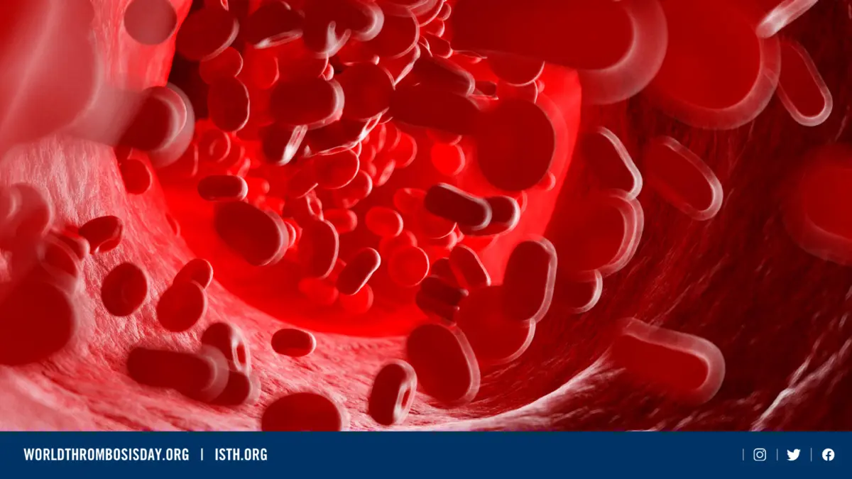 'ภาวะลิ่มเลือดอุดตัน' ภัยร้ายที่ควรรับมืออย่างเร่งด่วน