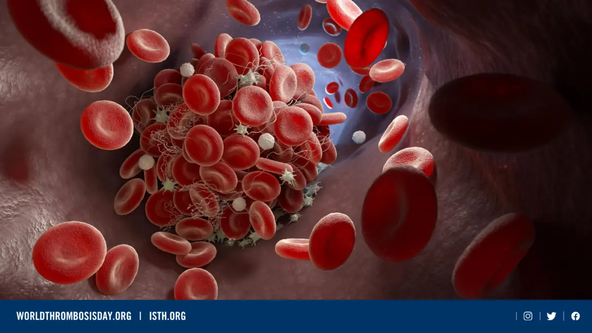 'ภาวะลิ่มเลือดอุดตัน' ภัยร้ายที่ควรรับมืออย่างเร่งด่วน