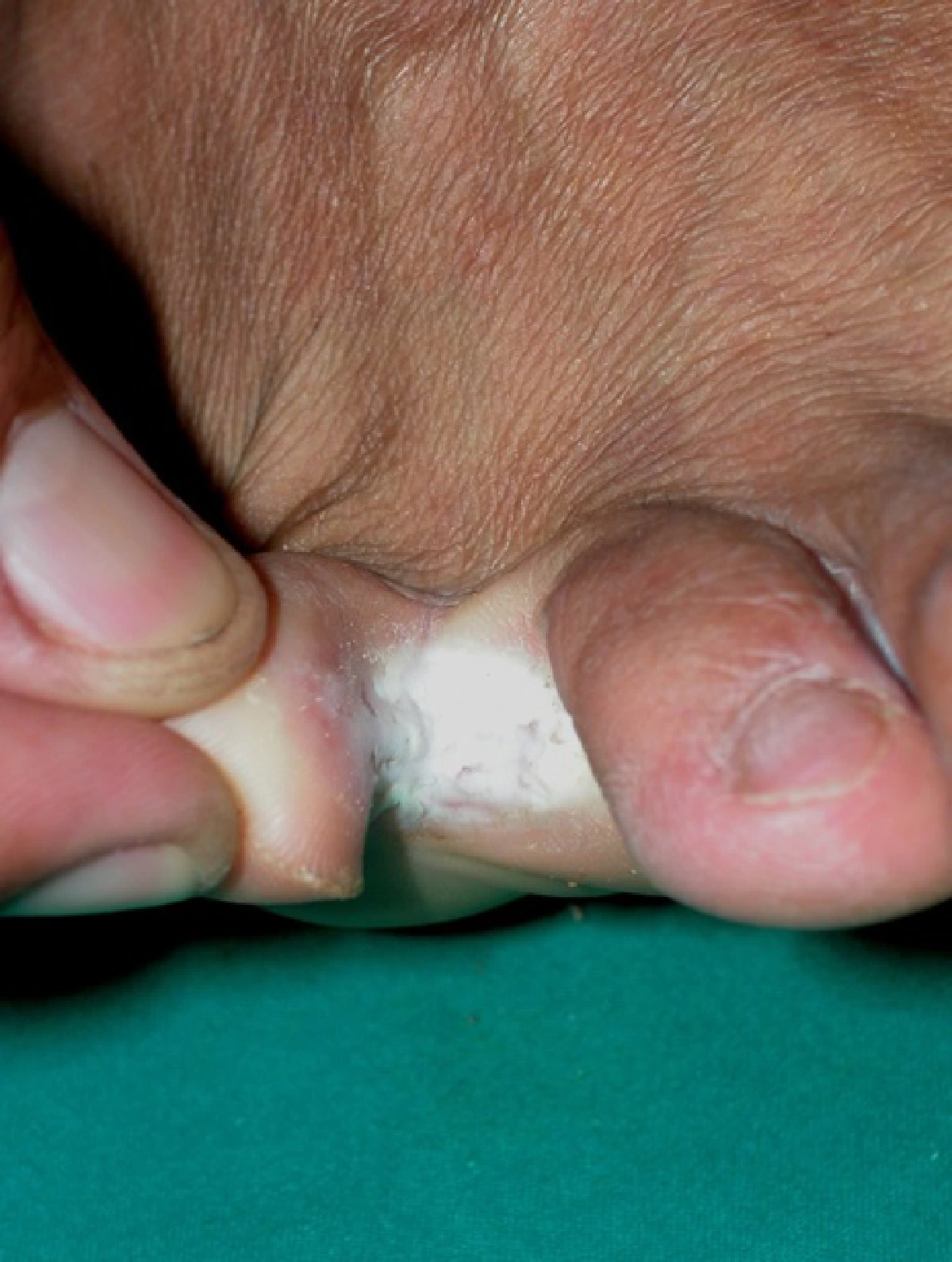 5 โรคผิวหนังเฝ้าระวังช่วงน้ำท่วม