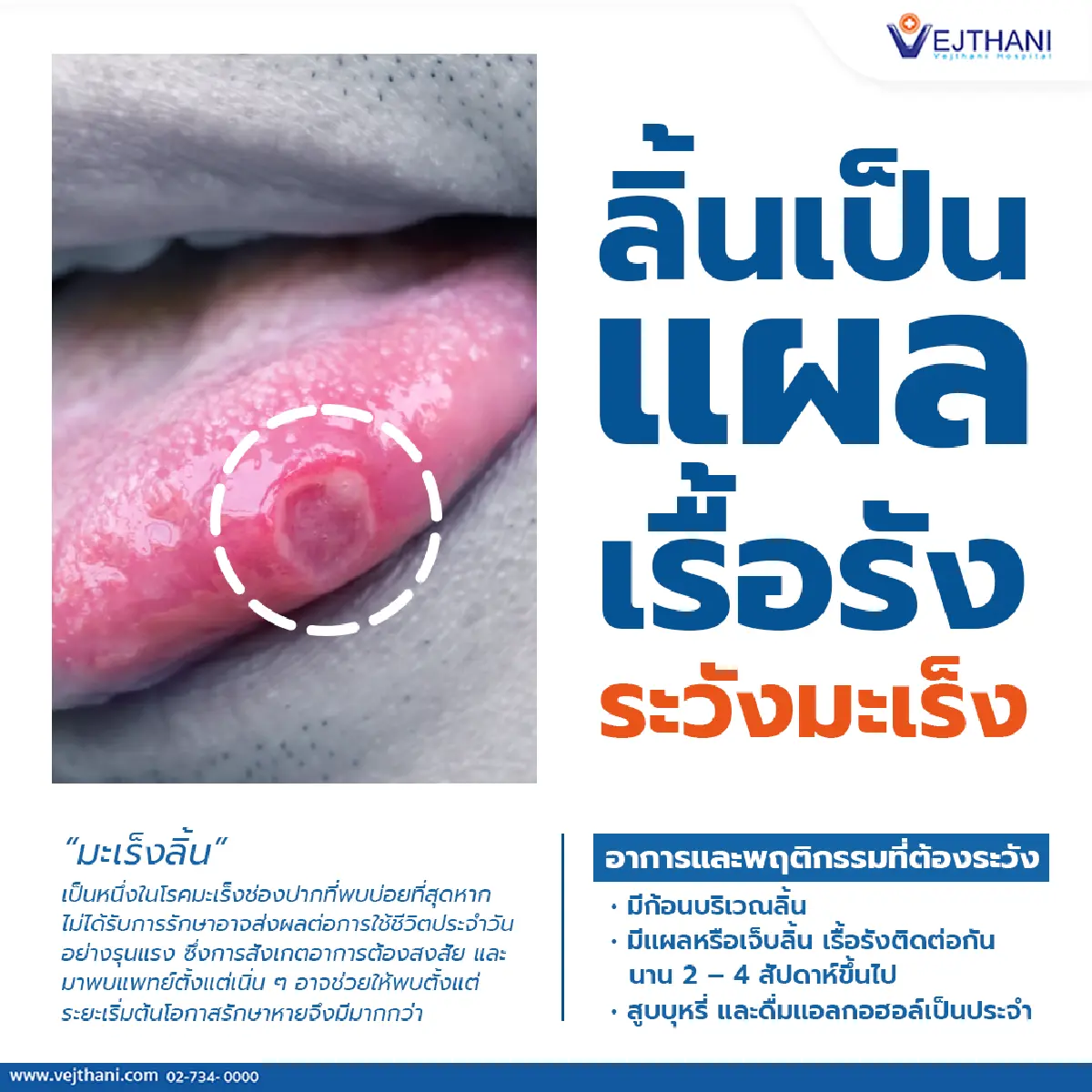 ลิ้นเป็นแผลเรื้อรัง ระวังโรคมะเร็งลิ้น!!