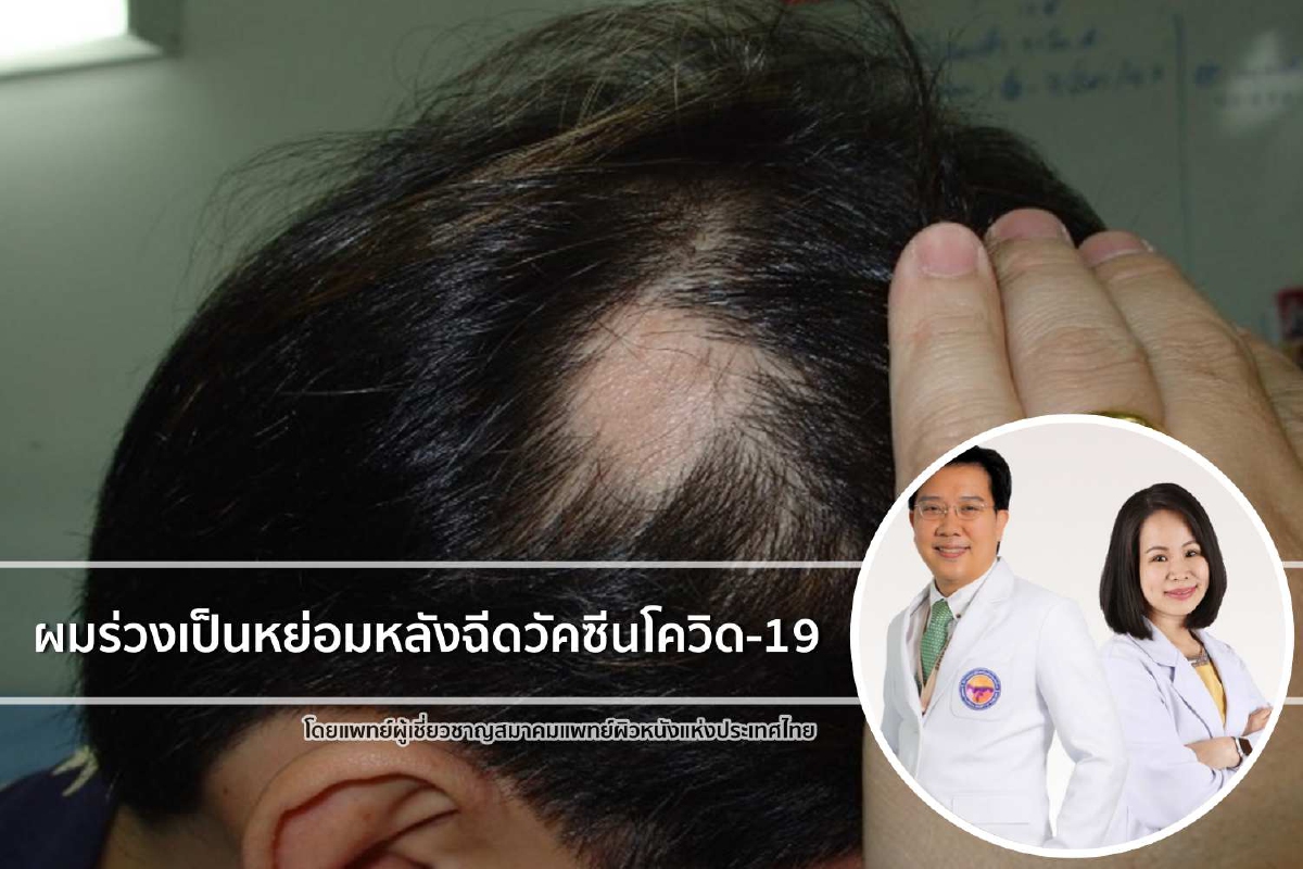 แพทย์ร่วมไขข้อสงสัย ผมร่วงเป็นหย่อมหลังฉีดวัคซีนโควิด-19 แพทย์ร่วมไขข้อสงสัย ผมร่วงเป็นหย่อมหลังฉีดวัคซีนโควิด-19