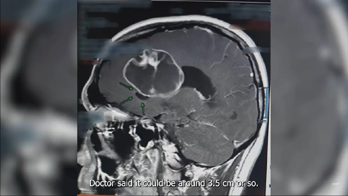 “ป๊อก ภัสสรกรณ์” ผ่าตัดสมองด่วน! เจอเนื้องอกใหญ่เกือบเท่าลูกเทนนิส