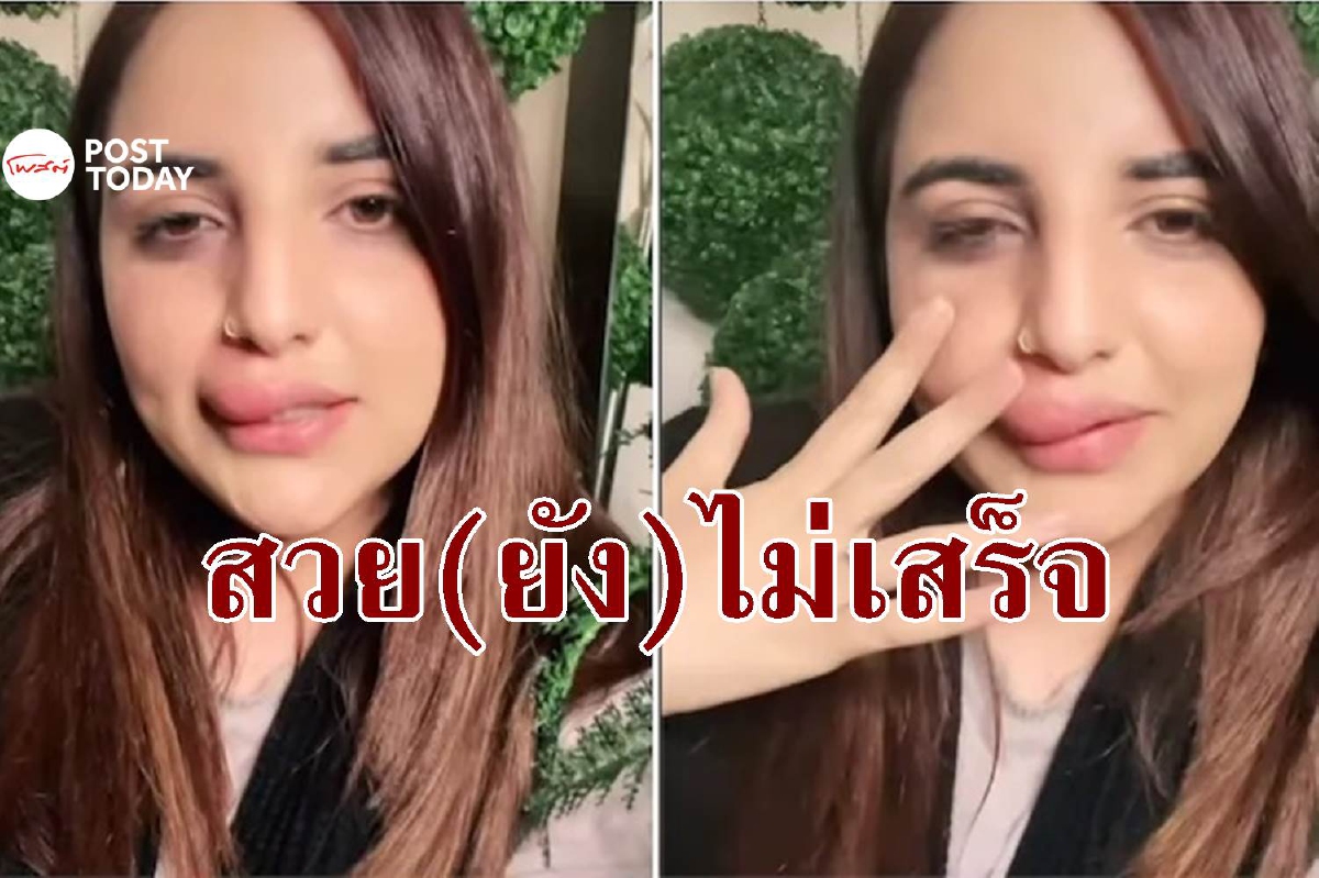สาวปากีฯ สวยแค่ครึ่งเดียวเพราะต้องยุติฉีดฟิลเลอร์ปากกลางคัน สาวปากีฯ สวยแค่ครึ่งเดียวเพราะต้องยุติฉีดฟิลเลอร์ปากกลางคัน