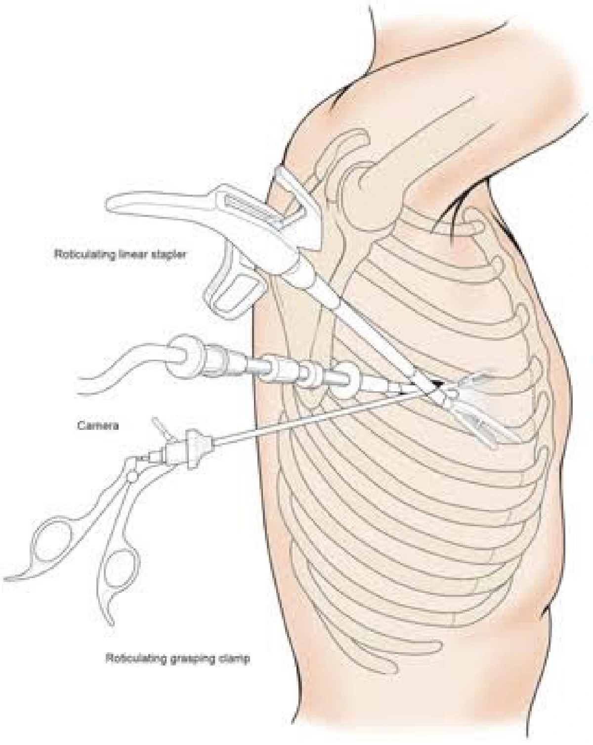 ส่องนวัตกรรมการแพทย์ : เทคโนโลยีการผ่าตัดส่องกล้องปอดขั้นสูง